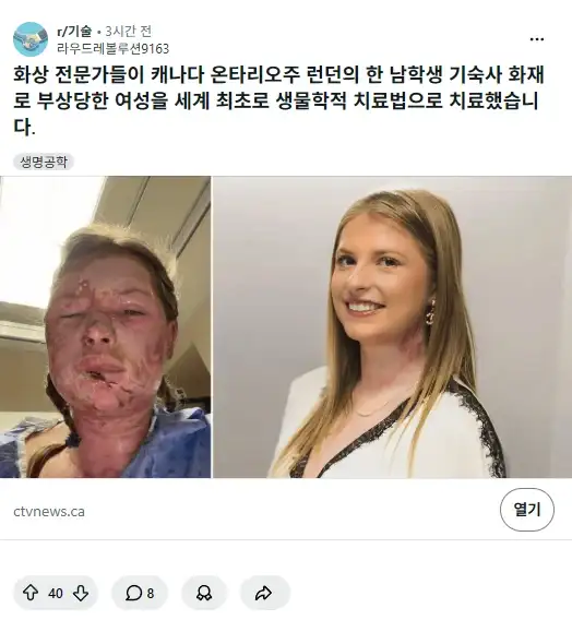 화상 환자 치료 신기술 근황
